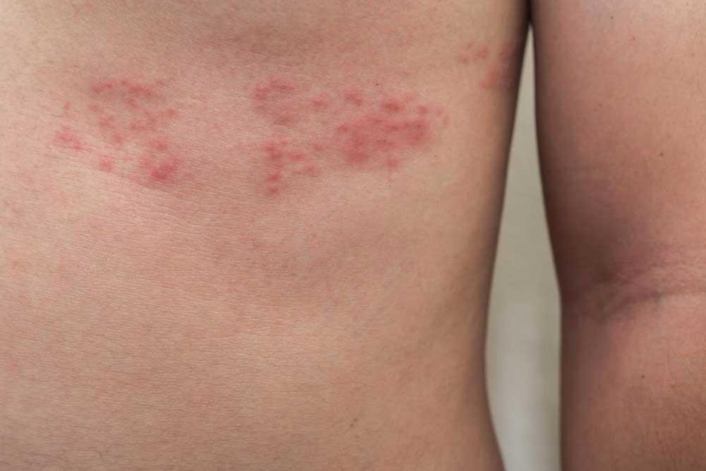 Effective Strategies for Managing Shingles Neuralgia Discomfort