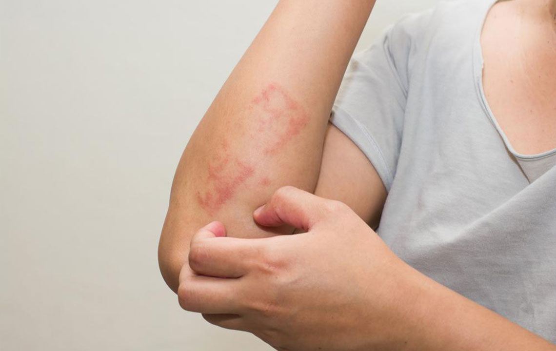 Effective Strategies for Managing Post-Shingles Nerve Pain