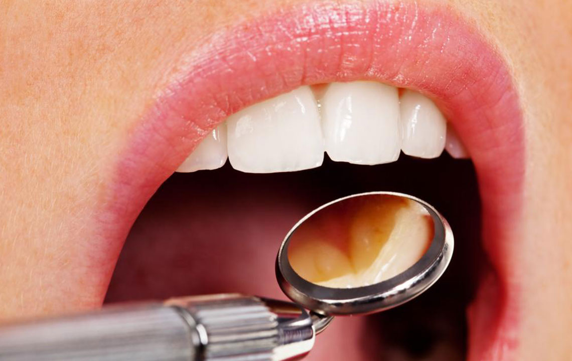 Comprehensive Guide to Common Myths and Truths About Dental Implants
