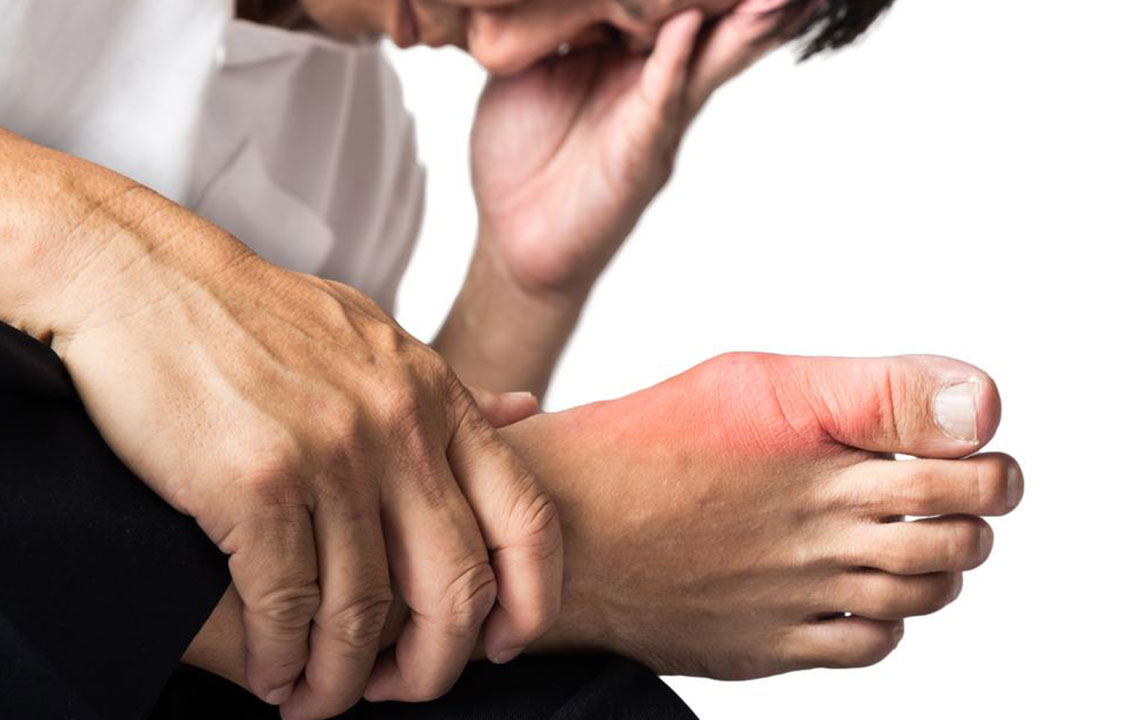 Understanding Gout: Symptoms and Effective Management Strategies