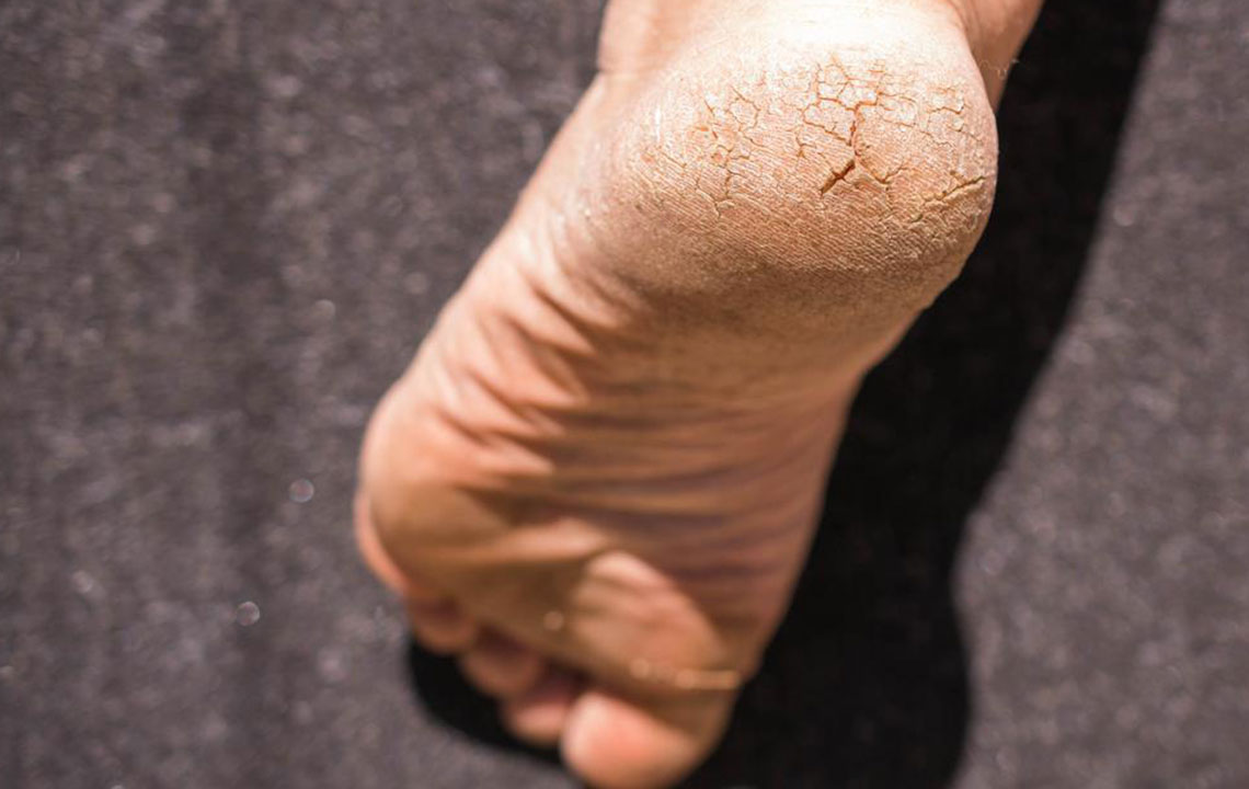 Natural Remedies to Ease Heel Discomfort
