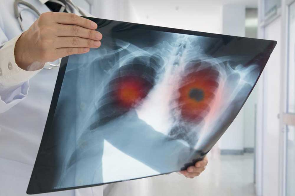 Comprehensive Guide to Pulmonary Fibrosis Treatment Options