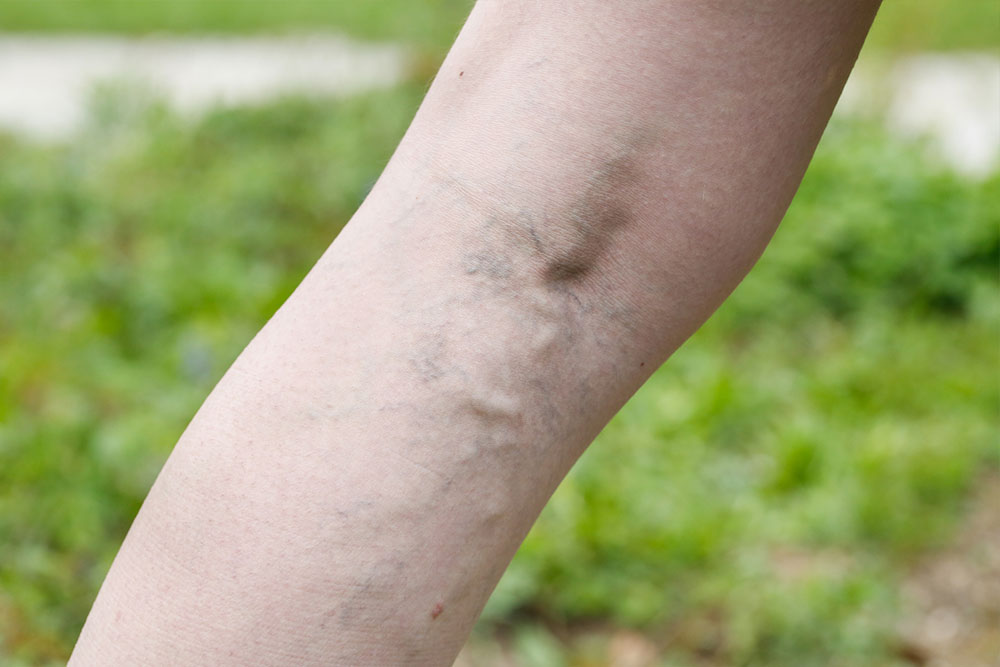 Understanding and Managing Varicose Vein Symptoms