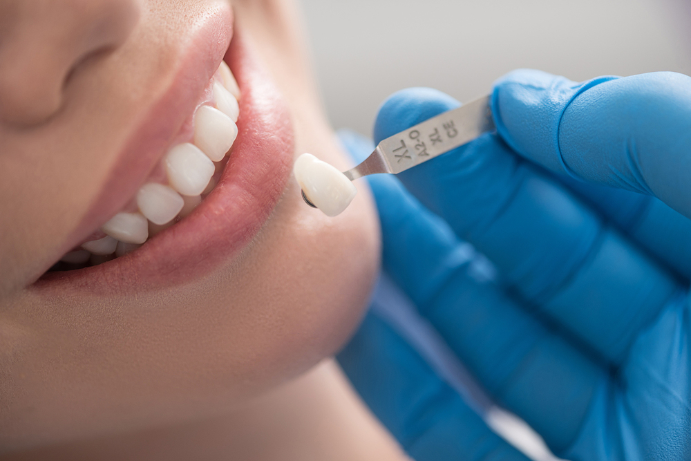 Ultimate Guide to Dental Crowns and Restorative Caps: Restoring Smile Strength and Aesthetics
