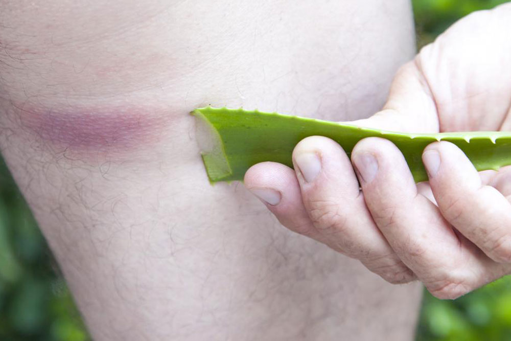Top Natural Remedies for Bee Sting Relief
