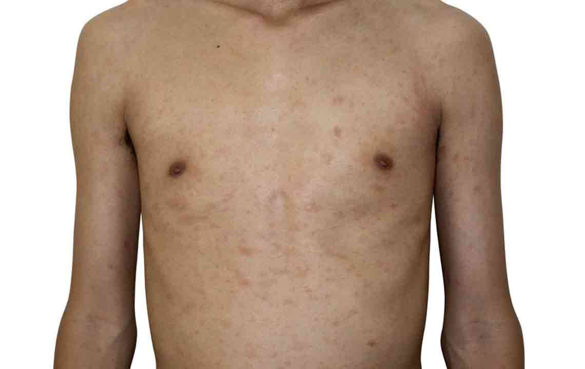 Comprehensive Guide to Pityriasis Rosea: Symptoms and Effective Treatments