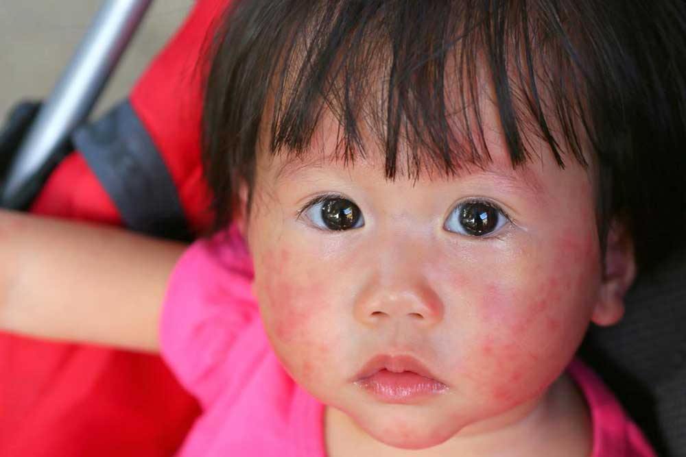 Understanding Skin Rashes: Types, Causes, and Symptoms