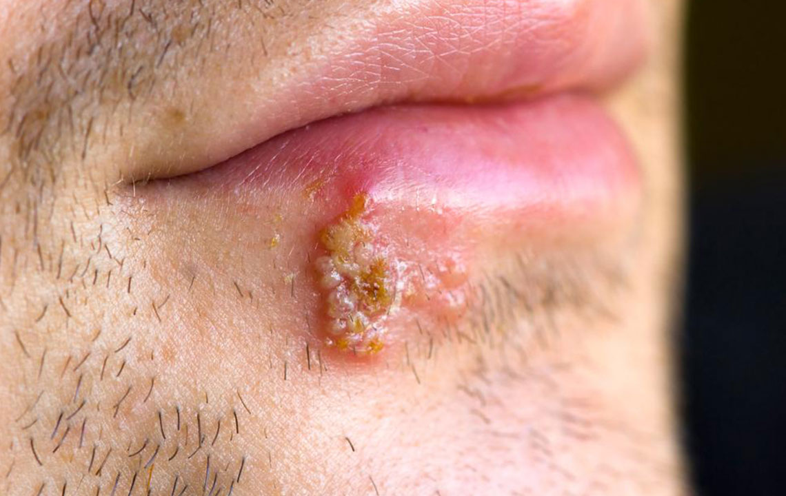 Comprehensive Guide to Recognizing Common Symptoms of Herpes Infection