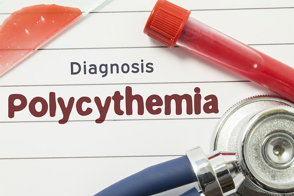 Understanding Polycythemia Vera: Symptoms, Causes, and Management