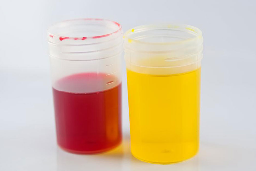 Understanding Urine Color: Causes, Symptoms, and When to Seek Medical Advice