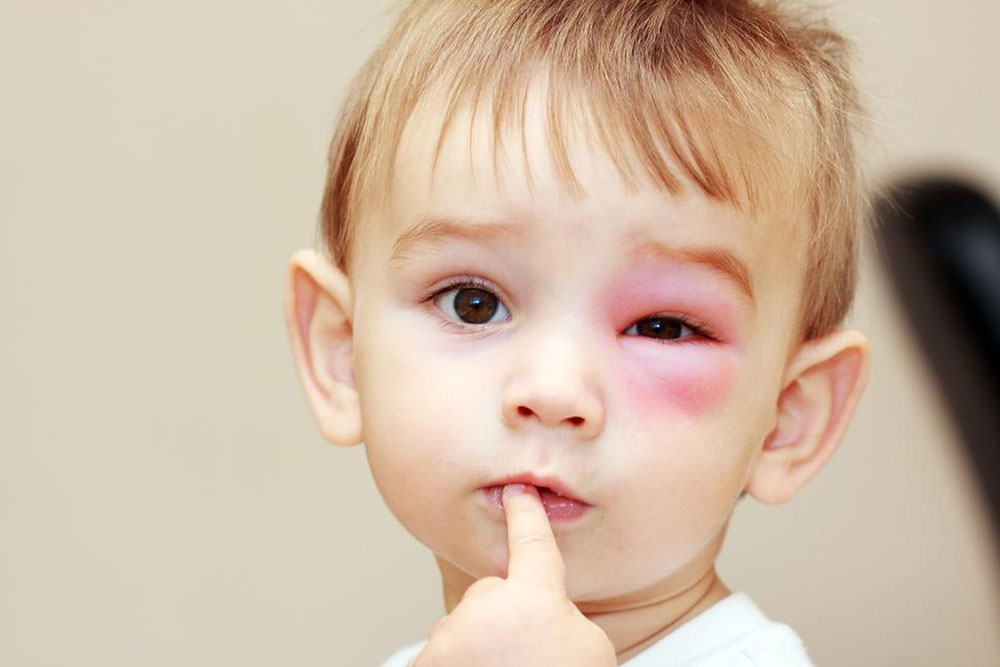 Top 4 Medical Approaches for Relief from Harmful Bee Stings