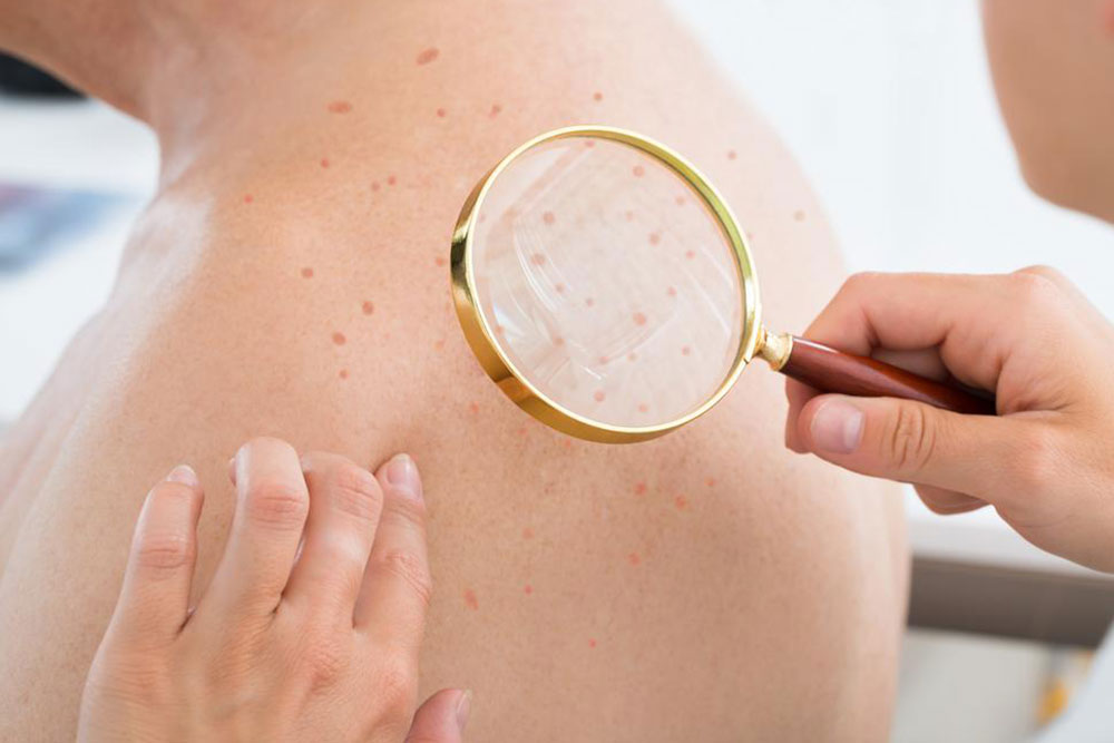 Essential Facts About Staph Infections Everyone Should Know