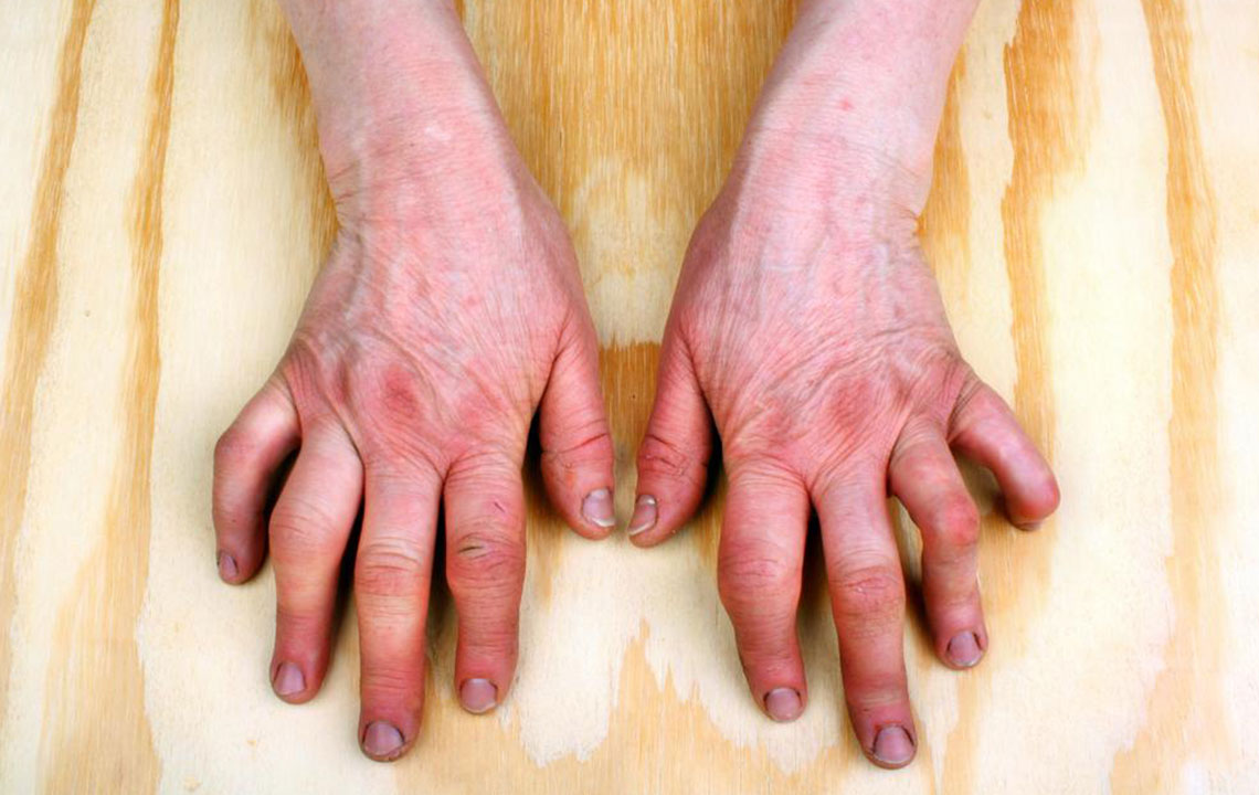 Recognizing Symptoms of Psoriatic Arthritis