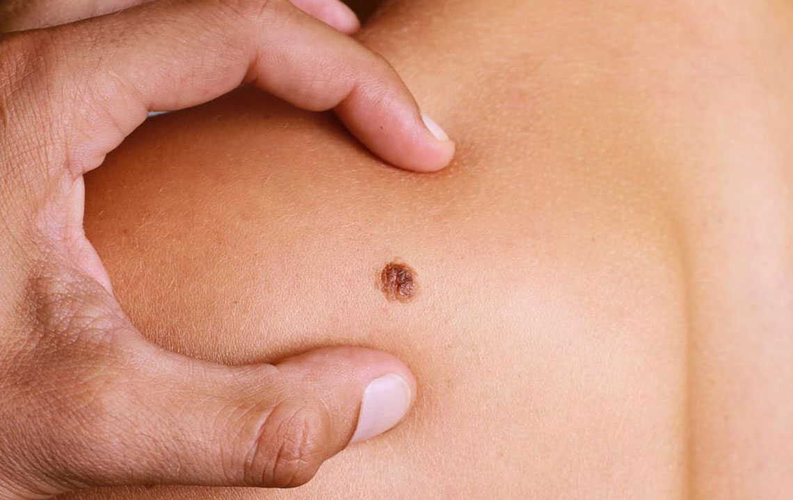 Understanding the Four Main Types of Melanoma and Treatment Options