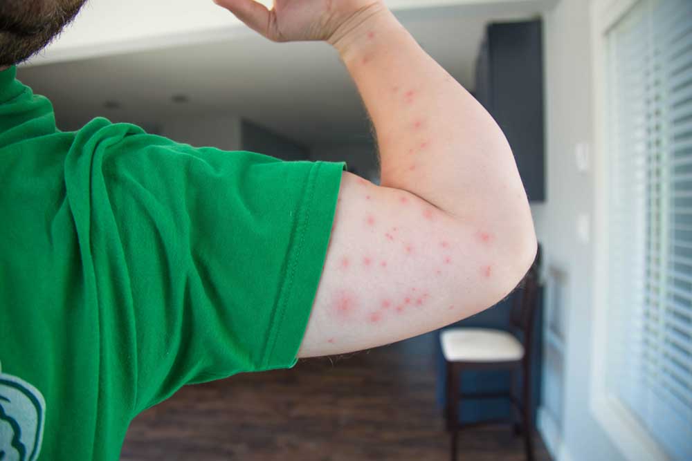 Signs and Remedies for Bedbug Bites