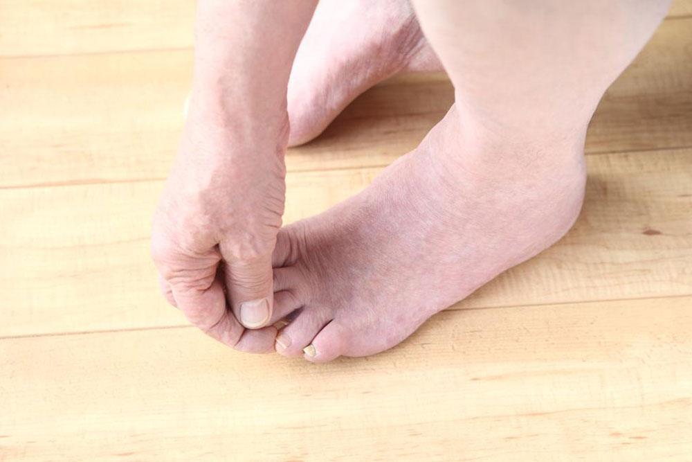 Essential Insights About Toenail Fungal Infections
