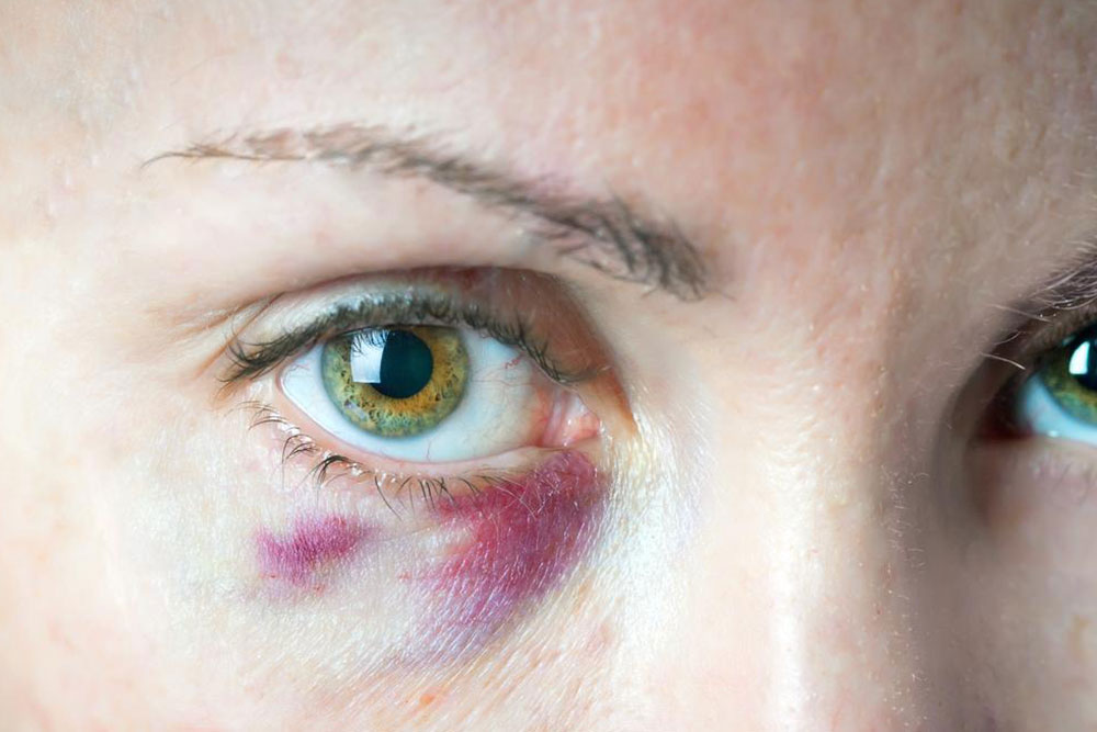 Effective Home Treatments for Quick Bruise Recovery