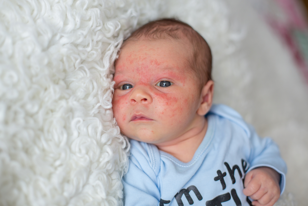 Understanding Eczema: Causes, Signs, and Effective Management