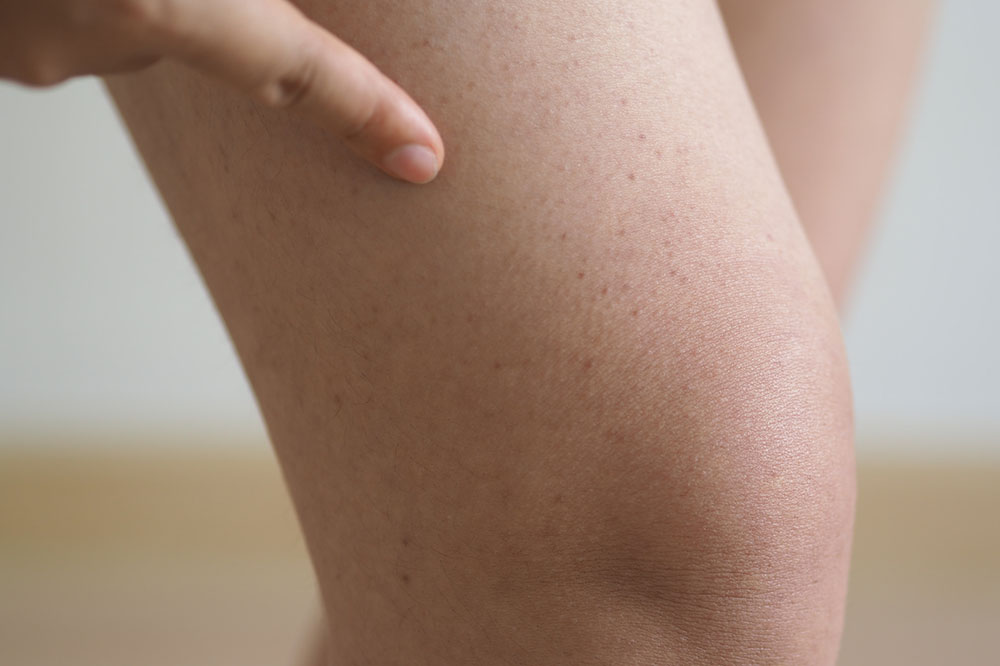 Effective Strategies for Managing Hemophilia