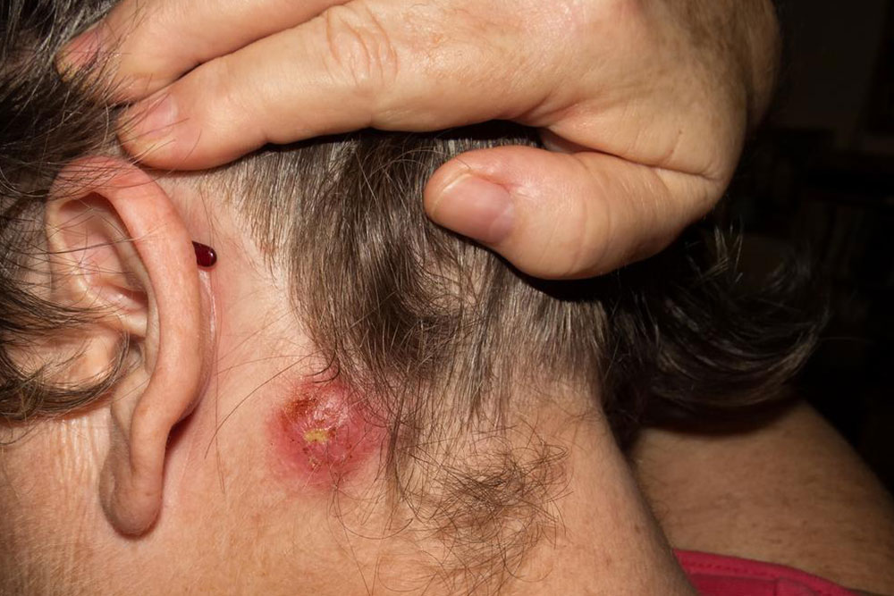Recognizing the Symptoms of Staphylococcal Infections