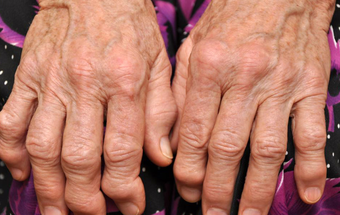 Top Strategies for Rapid Gout Pain Management