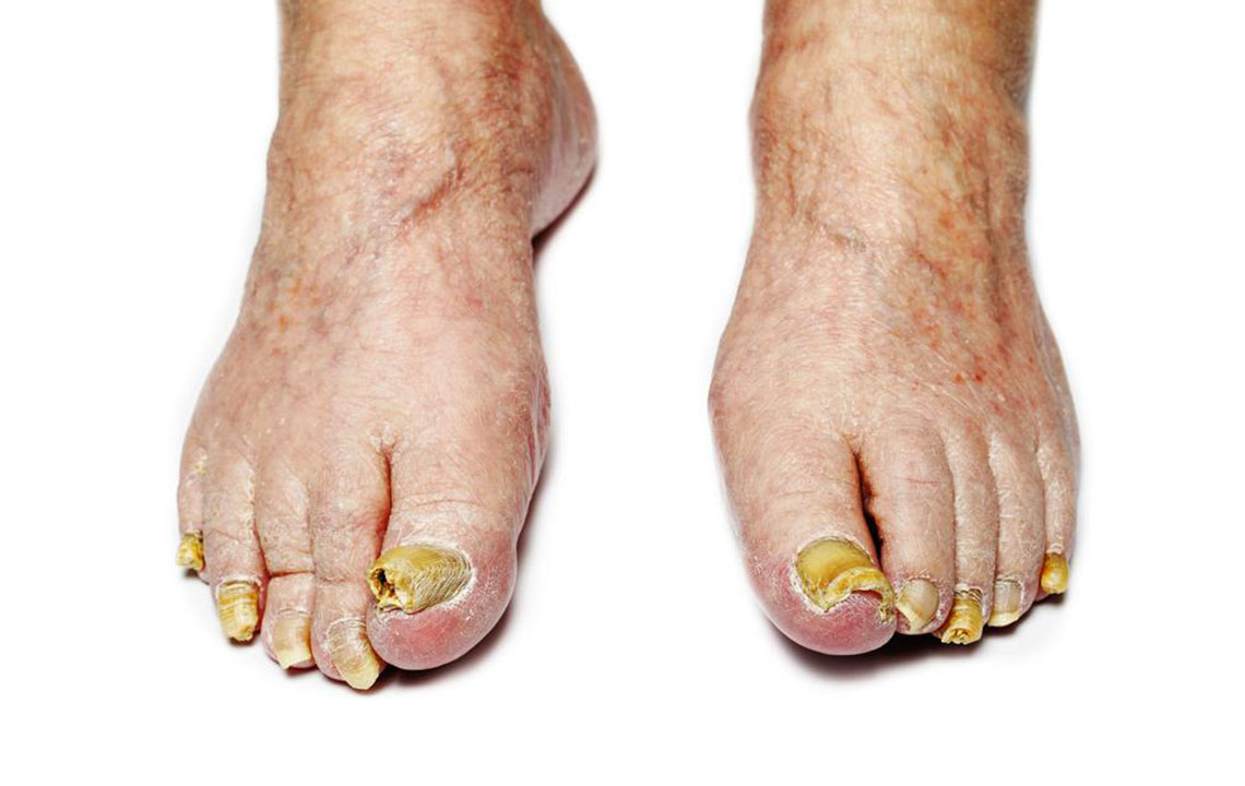 Signs, Causes, and Remedies for Nail Fungal Infections