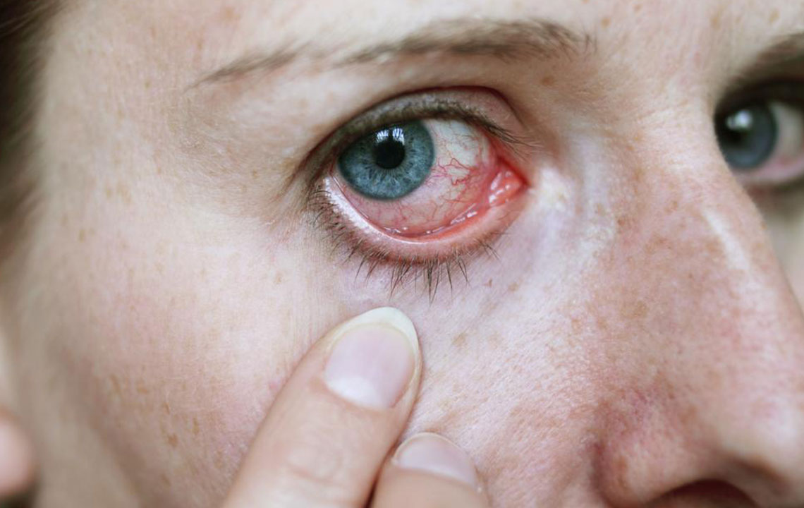 Effective Strategies for Managing Pink Eye with Eye Drops