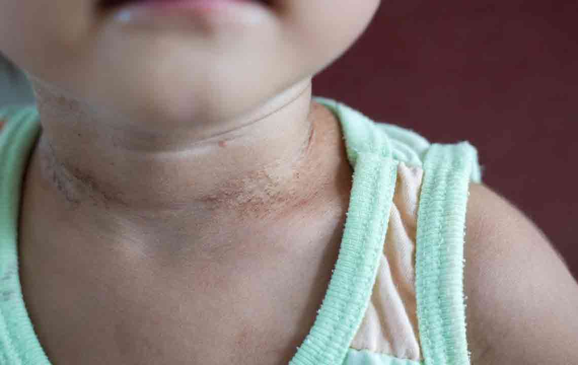 Recognizing Early Symptoms of Lupus for Timely Intervention