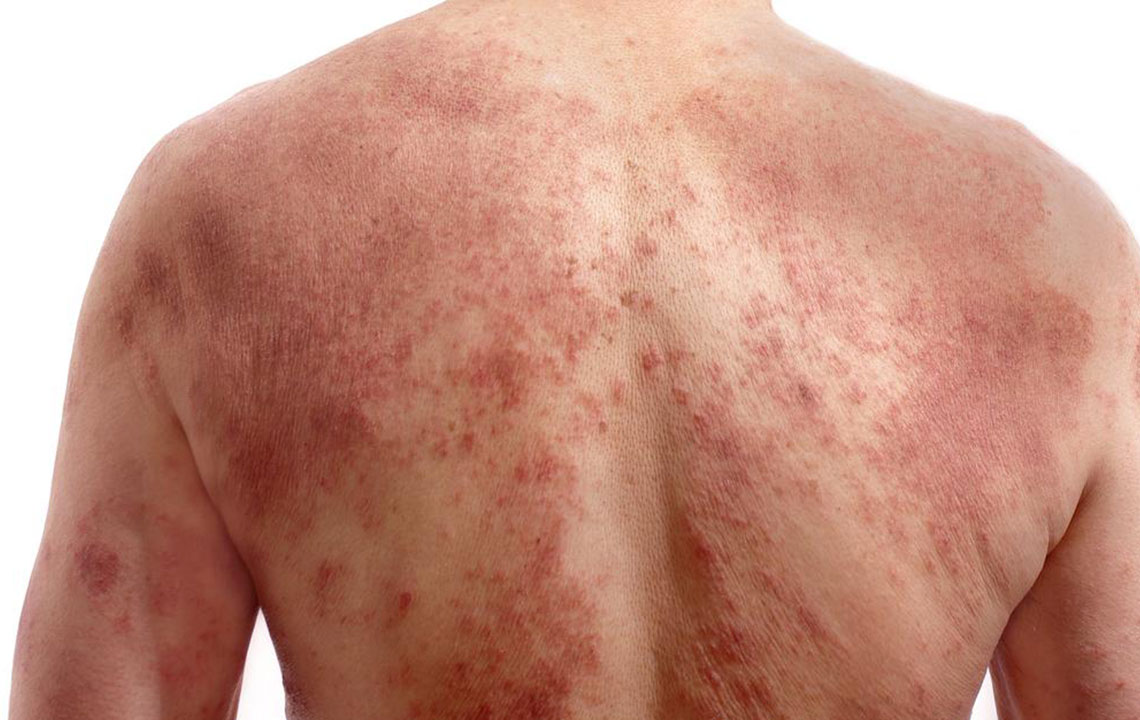 Advanced Strategies for Managing Postherpetic Neuralgia Pain