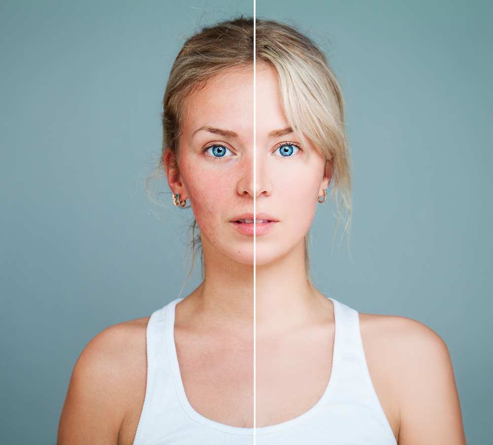 Comprehensive Guide to Managing Rosacea