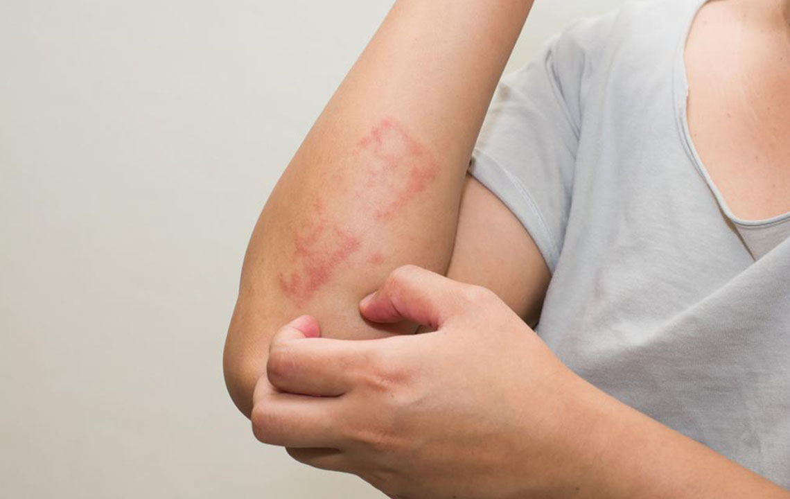Understanding Causes and Management of Atopic Dermatitis