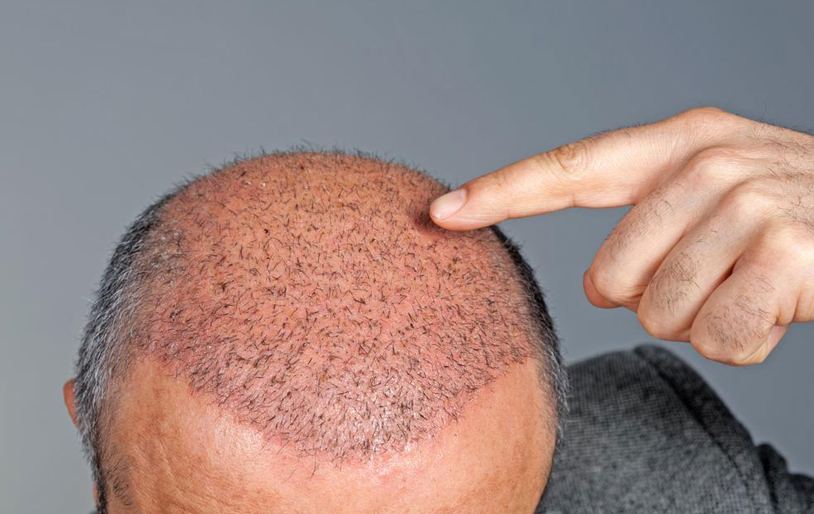 Comprehensive Guide to Hair Transplant Costs and Procedures