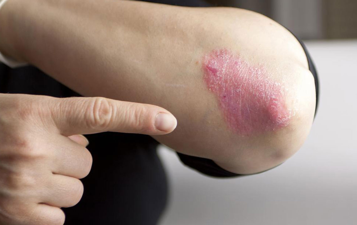 Essential Facts About Psoriasis You Should Know