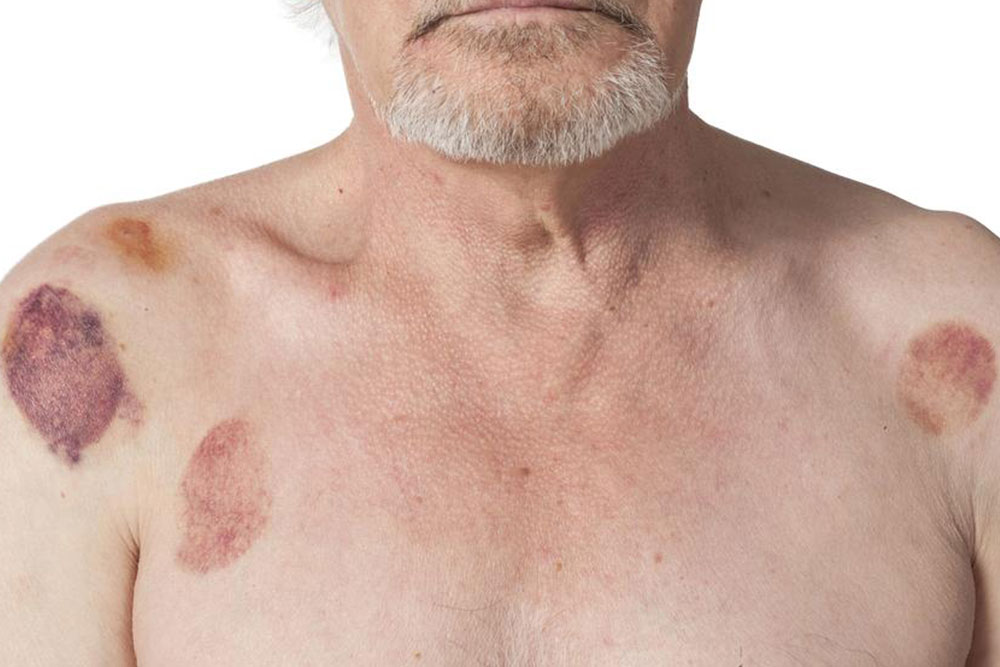 Effective Home Strategies for Hematoma Recovery