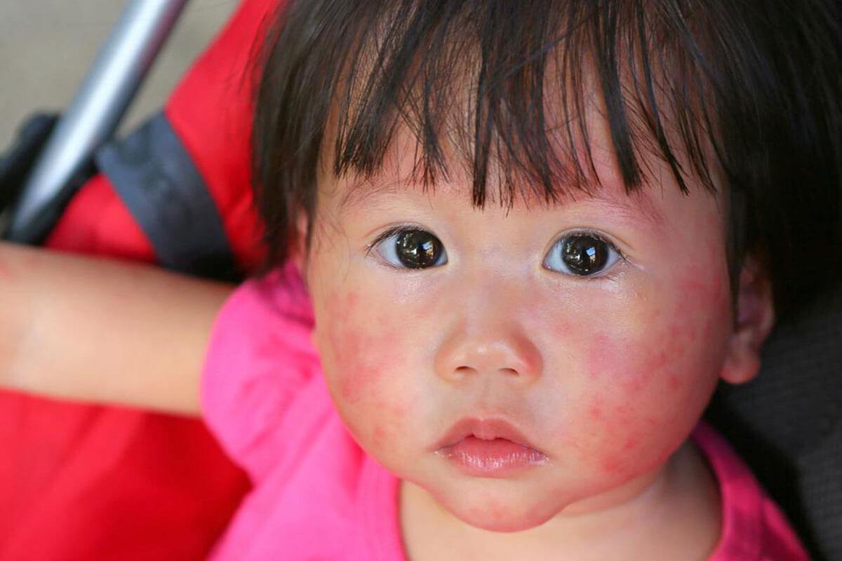 Comprehensive Guide to Detecting and Managing Childhood Allergies