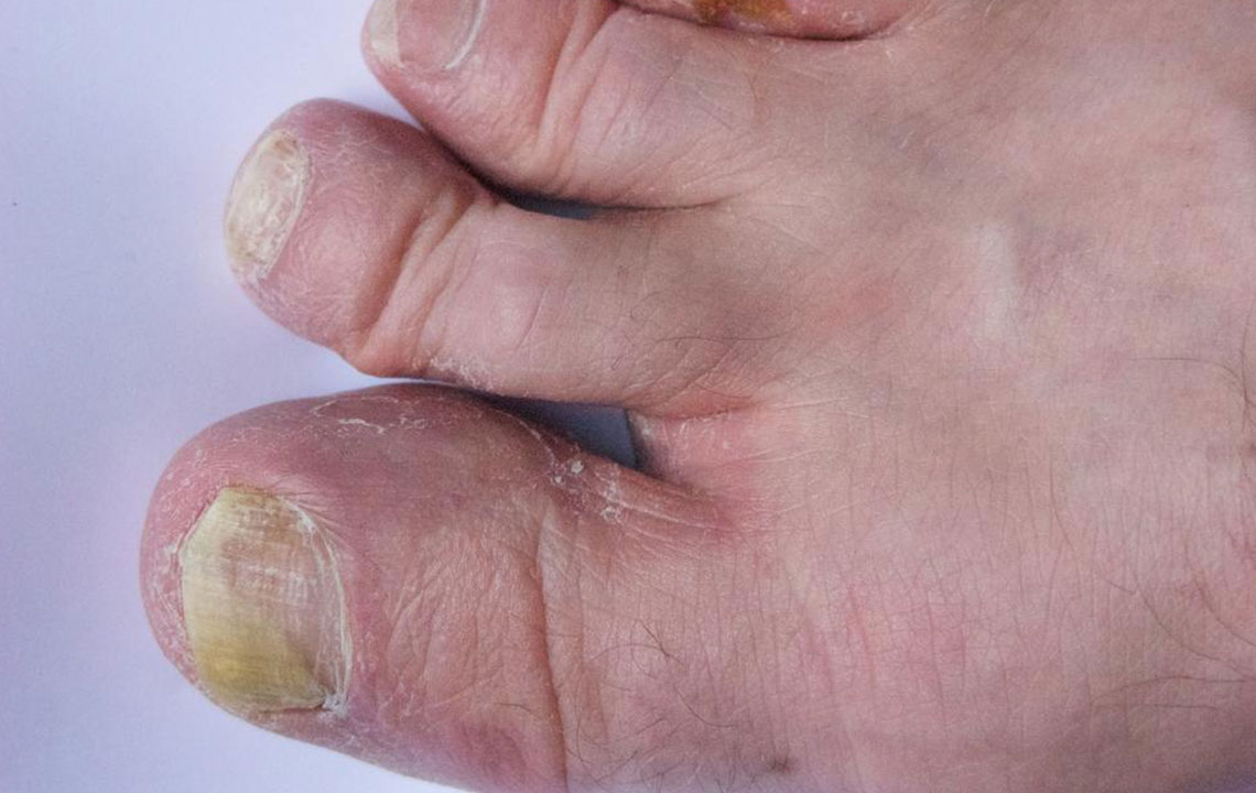 Effective Strategies for Managing Toenail Fungal Infections