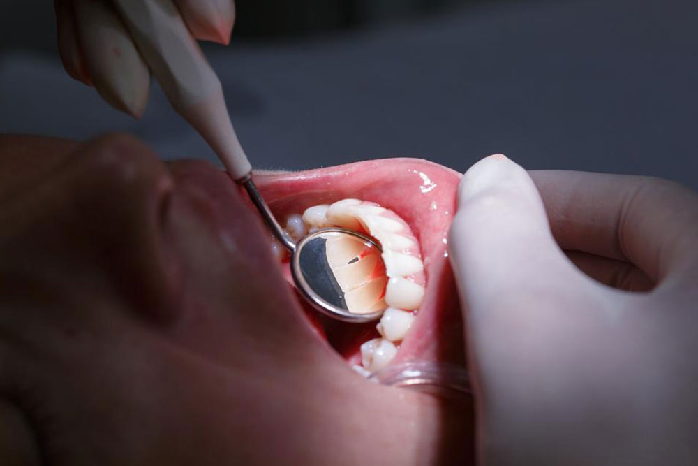 Effective Strategies to Restore Receding Gums