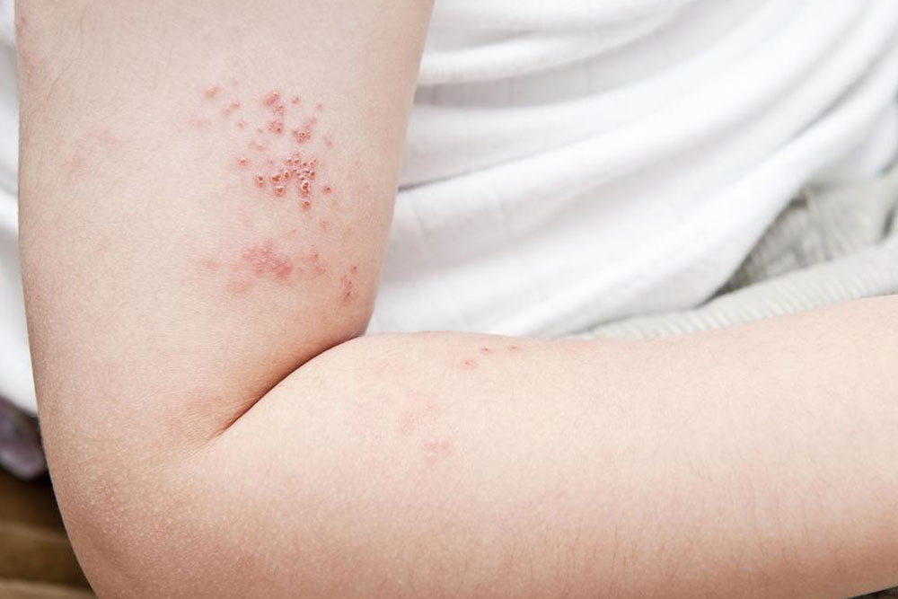Top Strategies for Managing Shingles Discomfort Effectively