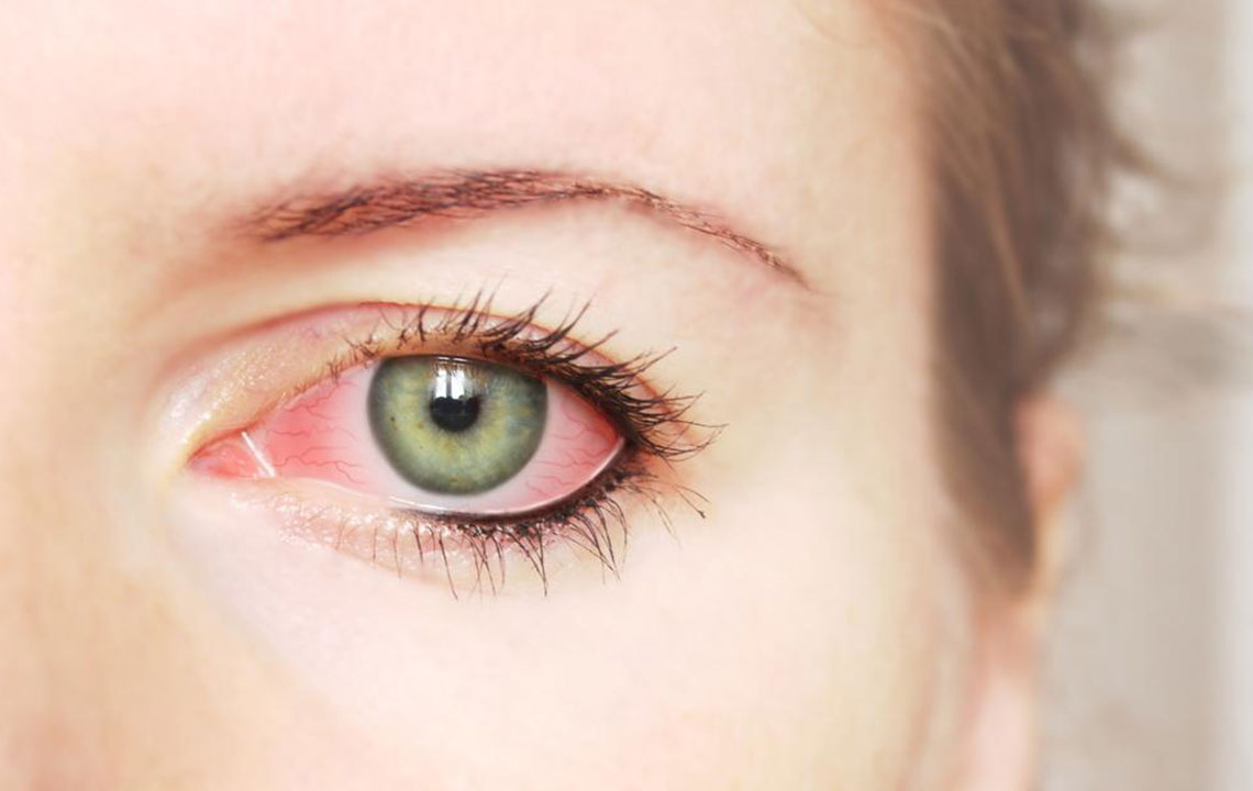 Understanding Red Eye: Common Causes and Effective Remedies