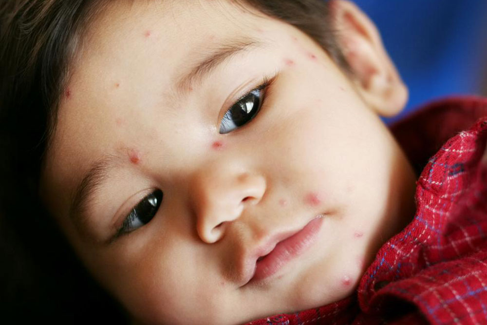 Recognizing the Key Symptoms of Chickenpox Early