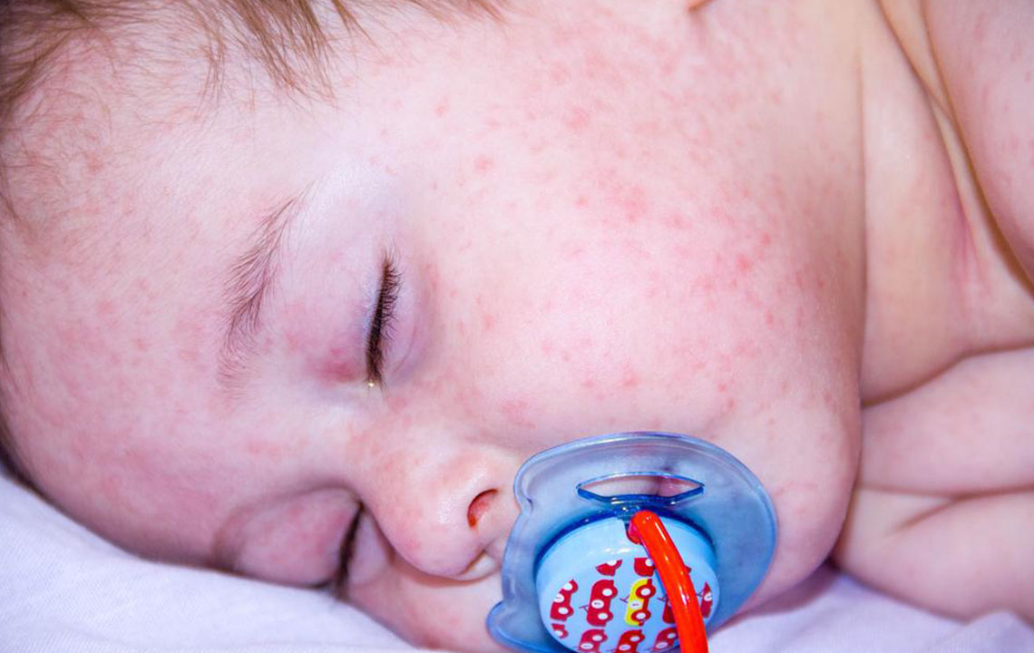 8 Effective Strategies for Managing Childhood Atopic Dermatitis