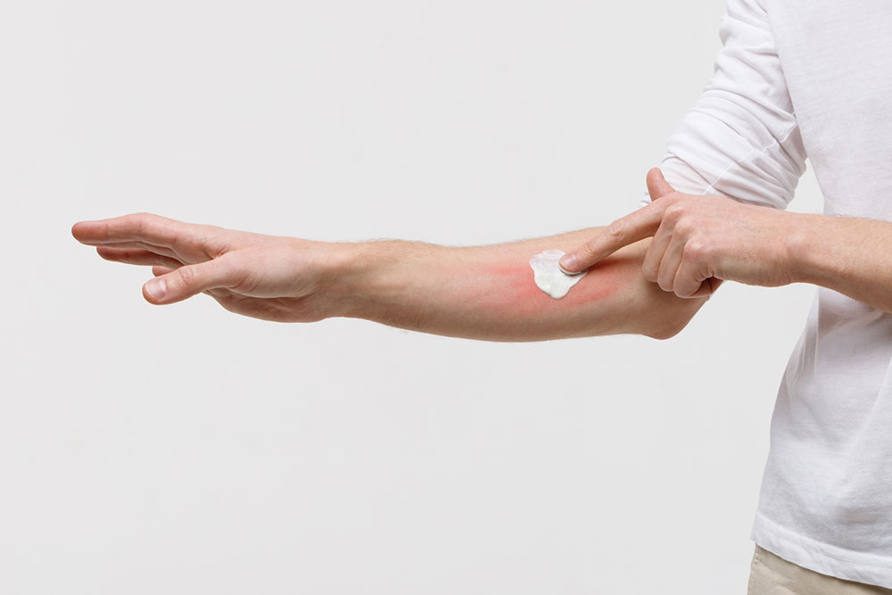 Understanding Types and Symptoms of Atopic Dermatitis