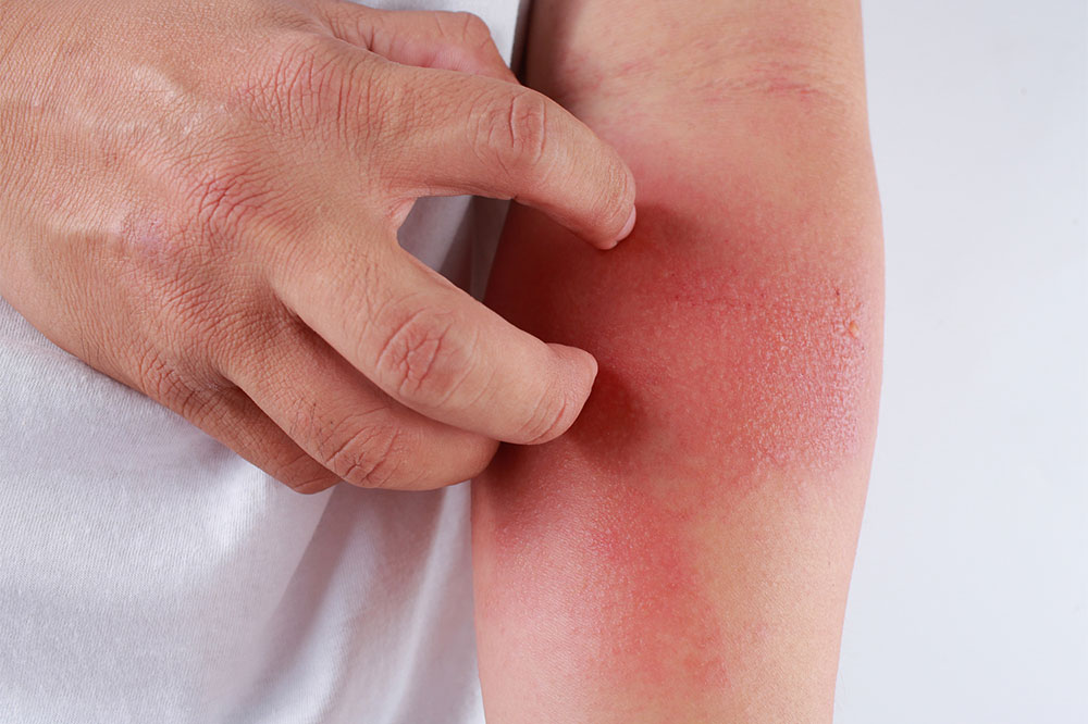 Comprehensive Guide to Selecting Safe Soaps for Eczema Management