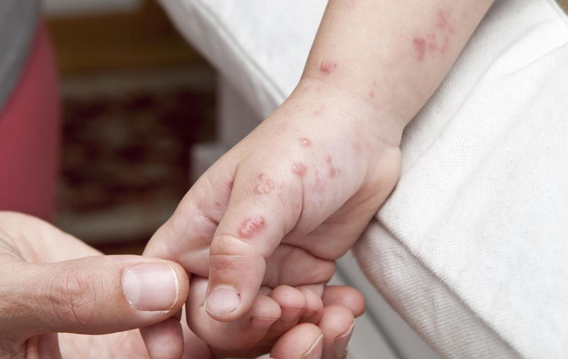 Effective Natural Remedies for Managing Shingles Discomfort