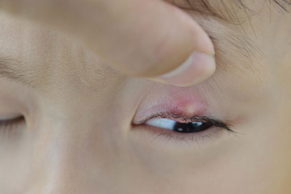 Effective Home Solutions to Manage Blepharitis