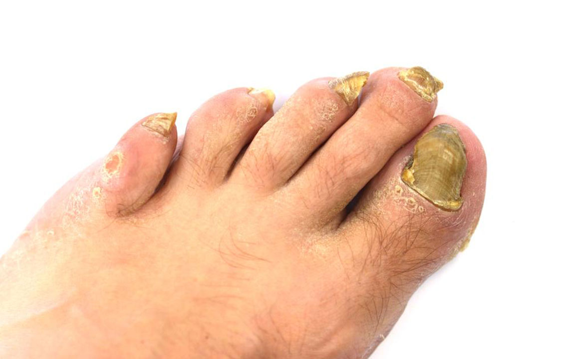 Natural Remedy for Toenail Fungus: Hydrogen Peroxide Secrets