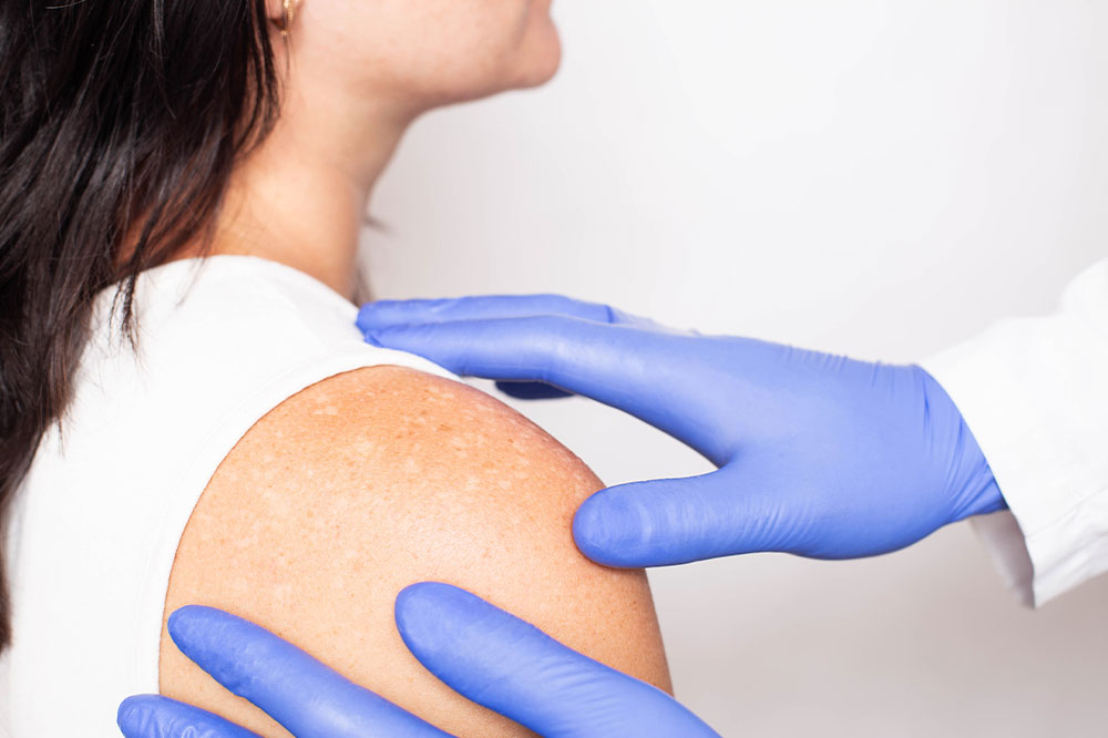 Understanding Vitiligo: Symptoms, Causes, and Management Strategies