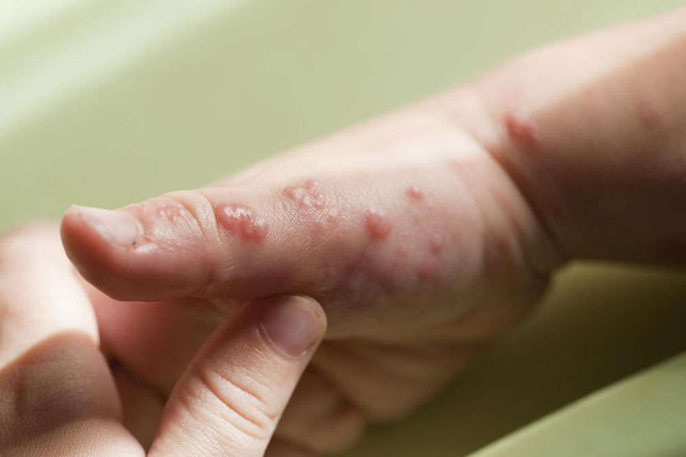 Effective Strategies to Manage Viral Infection Symptoms