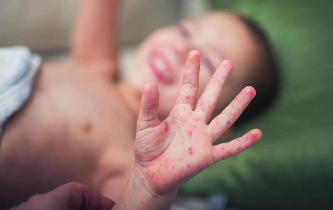 Comprehensive Guide to Managing and Preventing Infant Eczema: Effective Strategies and Remedies