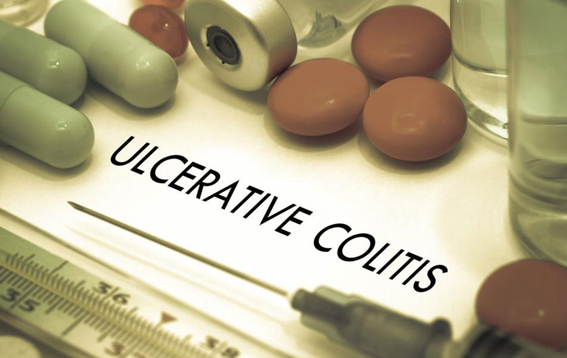 Effective Strategies for Managing Ulcerative Colitis